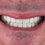 restauration de couronne en zircone bouche complète sur implants