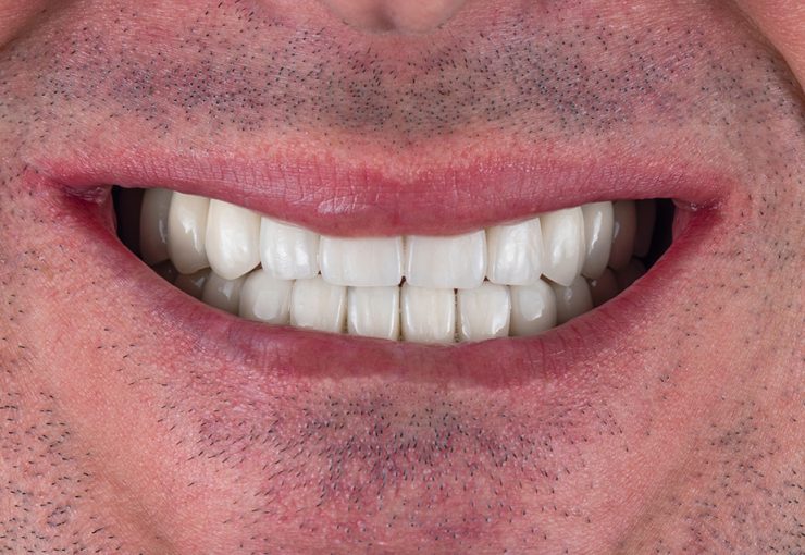 restauration de couronne en zircone bouche complète sur implants