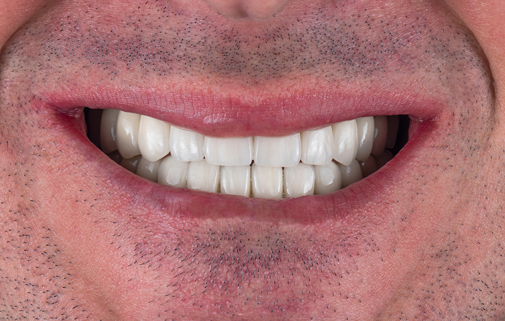 restauration de couronne en zircone bouche complète sur implants