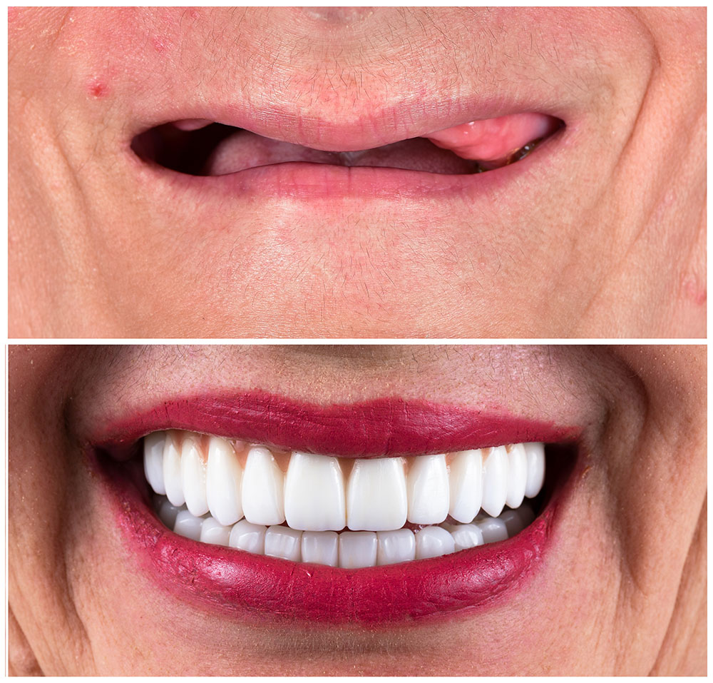 implant dentiste