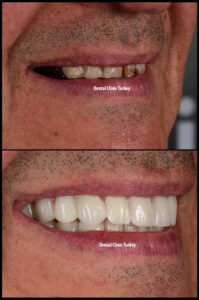 Smile Makeover