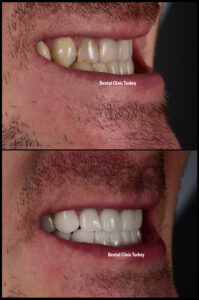 Dental Crowns