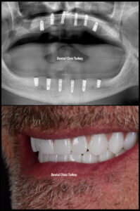 Full Mouth Implants and Zirconium Crowns
