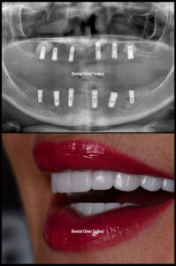 All on 6 and Smile Design