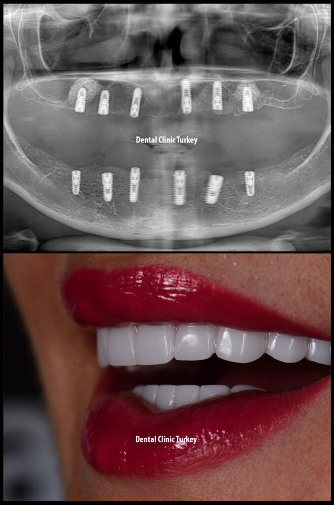 All on 6 and Smile Design