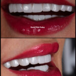 Hollywood smile with implant treatment