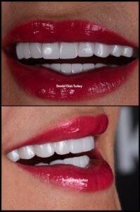 Hollywood smile with implant treatment