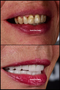 Dental Implants and Zirconium Crowns 2