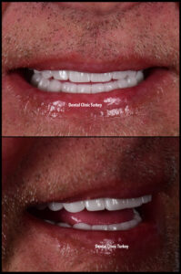 All on 6 - Zirconium Crowns