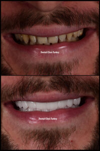 Smile Makeover