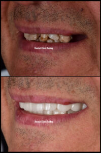 Smile Makeover2