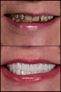 Full Set of Zirconium Crowns