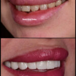 Hollywood Smile in Turkey