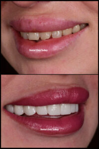 Hollywood Smile in Turkey