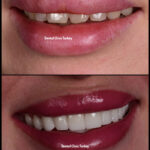 Hollywood Smile in Antalya