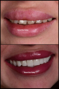 Hollywood Smile in Antalya