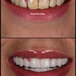 Full set of porcleian crowns