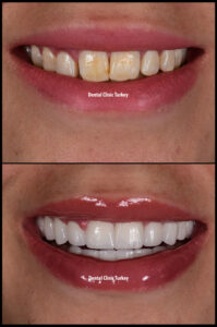 Full set of porcleian crowns