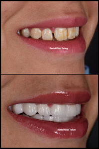 Full set of porcleian veneers