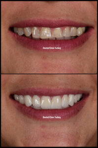 Smile Design in Dental Clinic