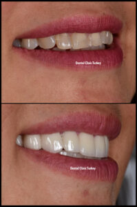 Before and After with Zirconium