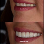 Smile Design - Antalya
