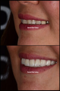 Smile Design - Antalya