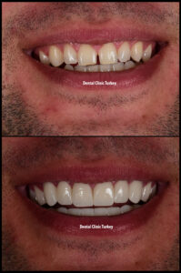Smile Makeover - Dentist