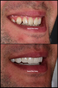 Turkey Dentist - Smile Design