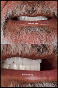 All on 6 and Zirconium