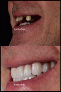 Dental Crowns and Dental Implants