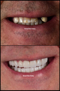 Smile Design with Zirconium