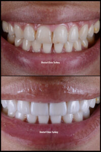 Porcelain Veneers