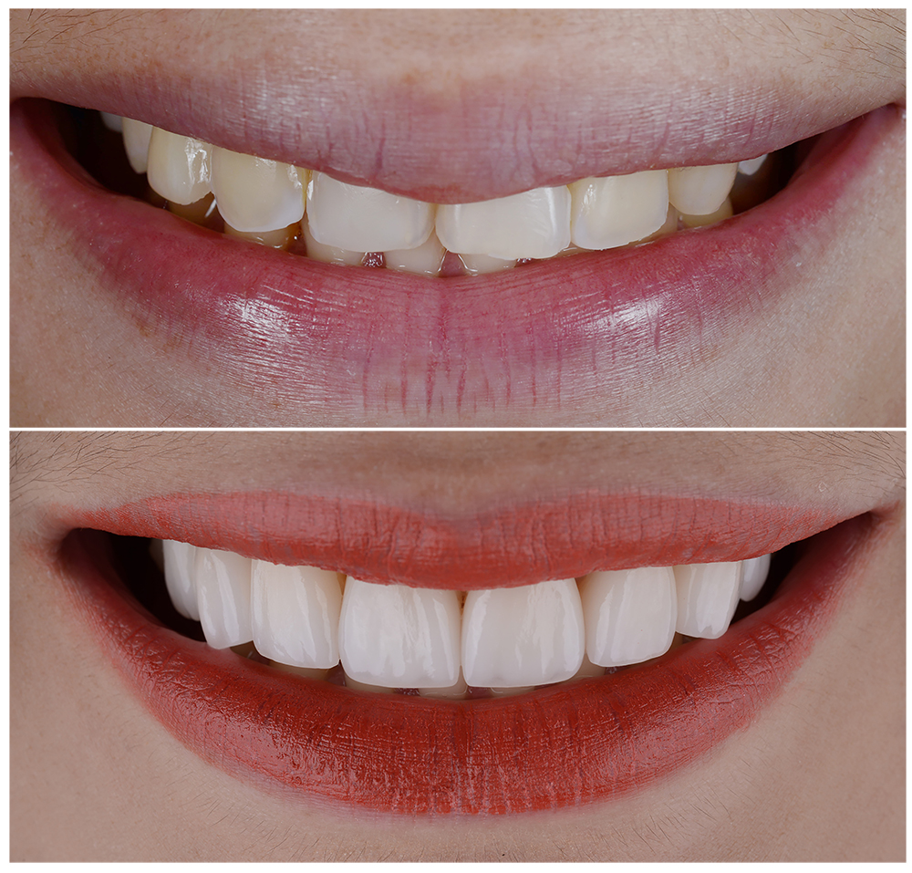 High-quality dental crowns in Turkey