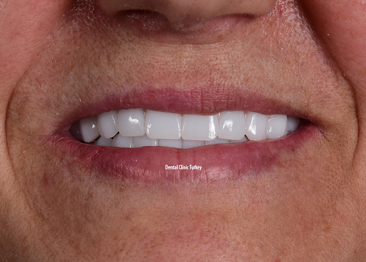Dental Implant in Turkey
