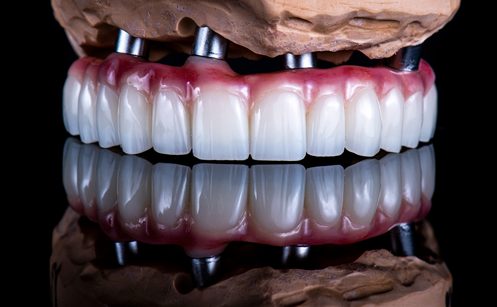 Affordable Dental Implants in Turkey
