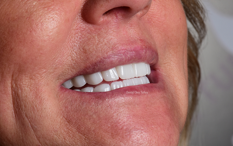 Zirconia Dental Crowns