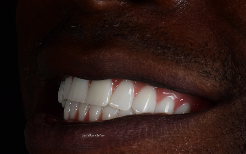 dental implant surgery in turkey