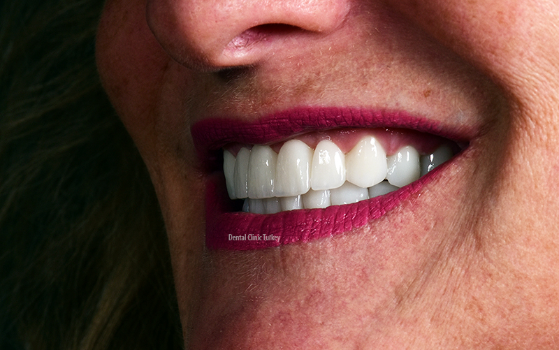 monolithic zirconia