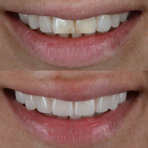 Perfect Smile with Turkey Dentist