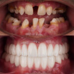 dental clinic turkey with dental implants full arch