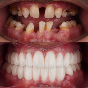 dental clinic turkey with dental implants full arch 