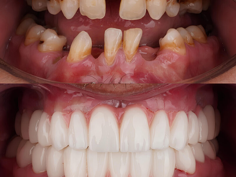 dental clinic turkey with dental implants full arch
