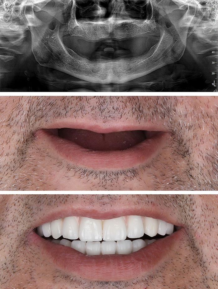 full mouth dental implants