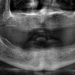 full mouth dental implants