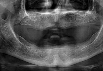 full mouth dental implants
