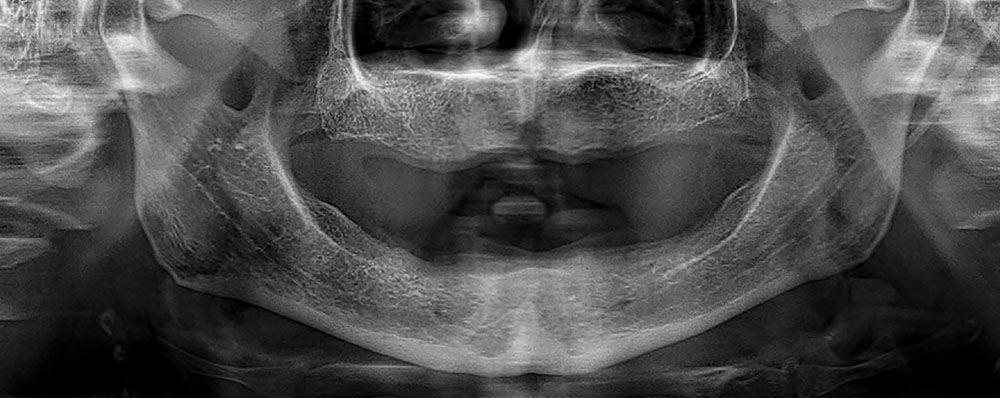 full mouth dental implants