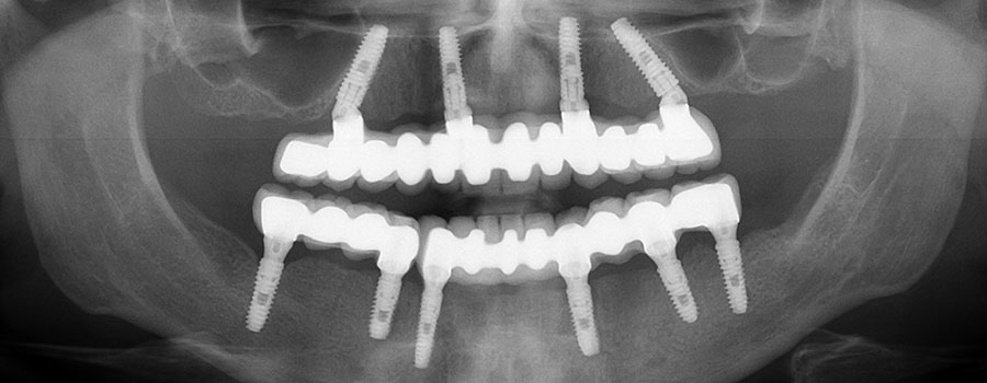 full mouth dental implants