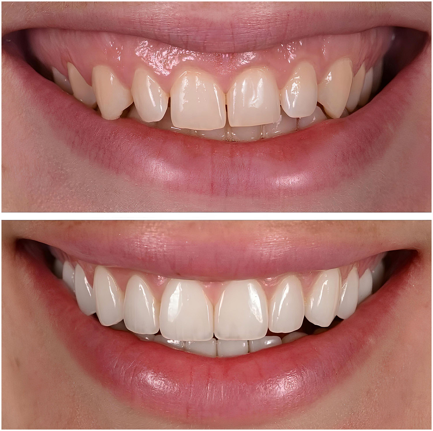 Emax Porcelain Veneers Turkey