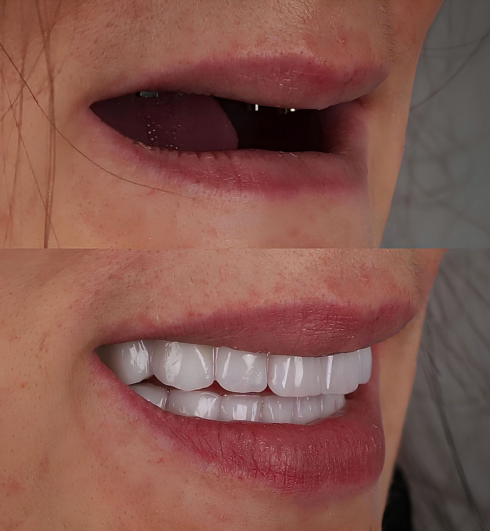 In,Dental,Implant,Jaw,Surgery,Treatment,,The,All-on-4,Or,All-on-x,